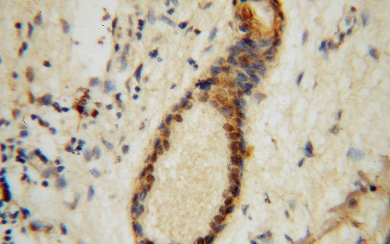 Immunohistochemical of paraffin-embedded human skin cancer using Catalog No:110509(EXOSC2 antibody) at dilution of 1:100 (under 40x lens)