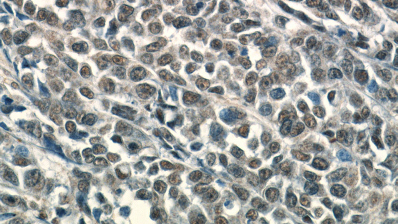 Immunohistochemical of paraffin-embedded human colon cancer using Catalog No:112254(KU70,XRCC6 antibody) at dilution of 1:50 (under 40x lens)