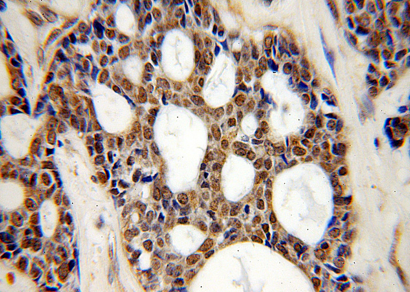 Immunohistochemical of paraffin-embedded human cervical cancer using Catalog No:115388(SMEK2 antibody) at dilution of 1:100 (under 40x lens)