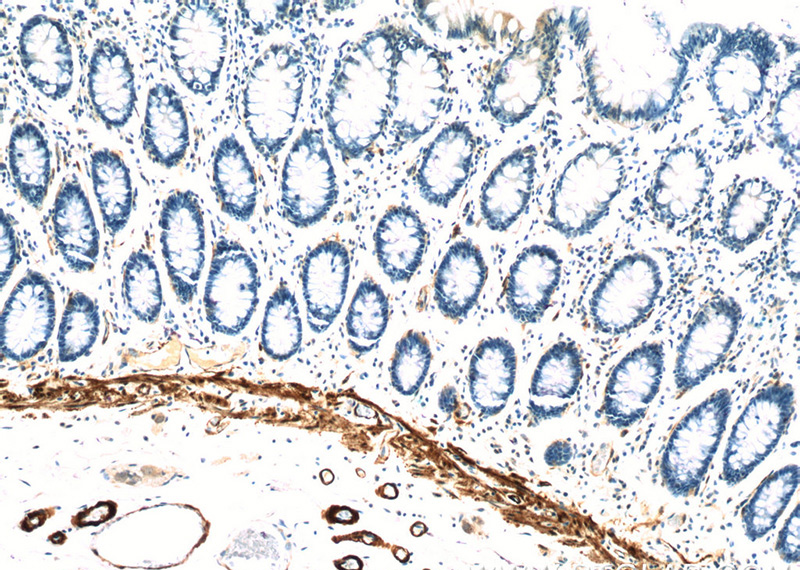 Immunohistochemistry of paraffin-embedded human colon tissue slide using Catalog No:116334(TRANSGELIN-1-specific Antibody) at dilution of 1:200 (under 10x lens)