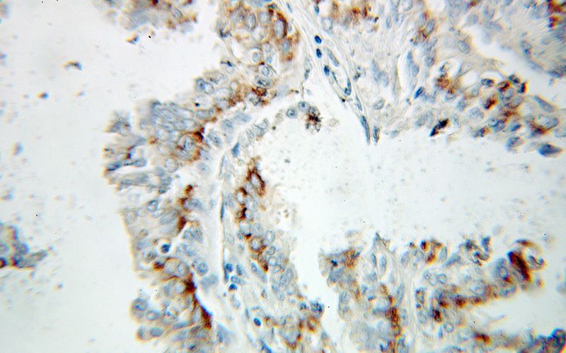 Immunohistochemical of paraffin-embedded human breast cancer using Catalog No:110398(HSD17B10 antibody) at dilution of 1:100 (under 10x lens)