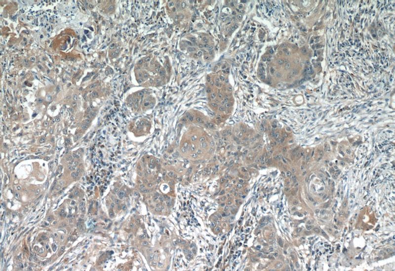 Immunohistochemistry of paraffin-embedded human lung cancer tissue slide using Catalog No:107688(ACP1 Antibody) at dilution of 1:50 (under 10x lens)