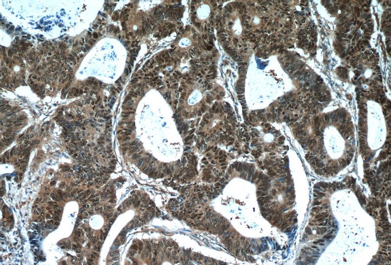 Immunohistochemistry of paraffin-embedded human colon cancer tissue slide using Catalog No:117270(ZWILCH Antibody) at dilution of 1:50 (under 10x lens)