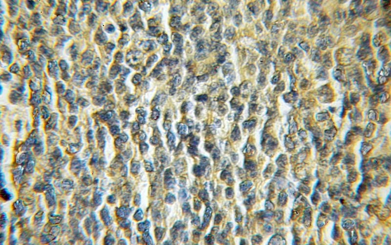 Immunohistochemical of paraffin-embedded human lymphoma using Catalog No:113056(NDOR1 antibody) at dilution of 1:50 (under 40x lens)