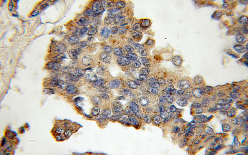Immunohistochemical of paraffin-embedded human breast cancer using Catalog No:108893(CTSK antibody) at dilution of 1:100 (under 10x lens)