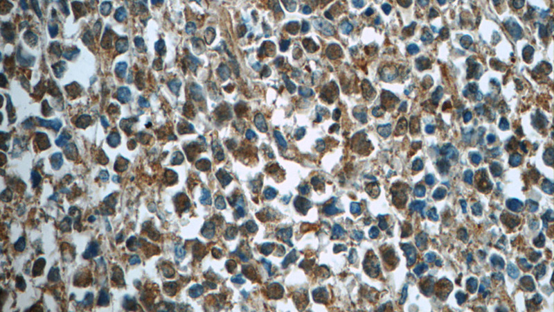 Immunohistochemistry of paraffin-embedded human lymphoma tissue slide using Catalog No:107147(CDK2 Antibody) at dilution of 1:50 (under 40x lens)