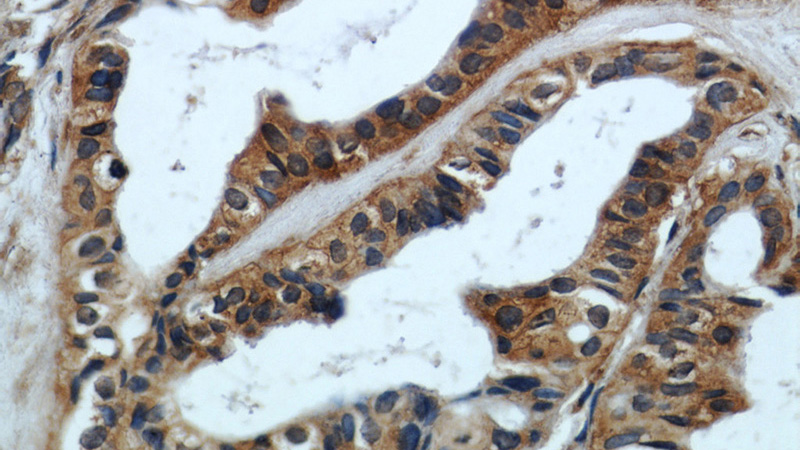 Immunohistochemical of paraffin-embedded human breast cancer using Catalog No:112359(LTBP1 antibody) at dilution of 1:50 (under 40x lens)