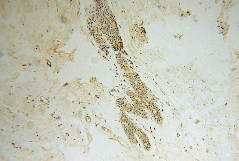 Immunohistochemical of paraffin-embedded human colon cancer using Catalog No:115535(SPAG7 antibody) at dilution of 1:50 (under 10x lens)