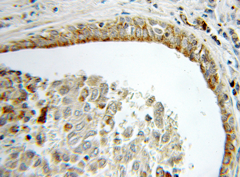 Immunohistochemical of paraffin-embedded human lung cancer using Catalog No:107824(ACAA2 antibody) at dilution of 1:100 (under 10x lens)
