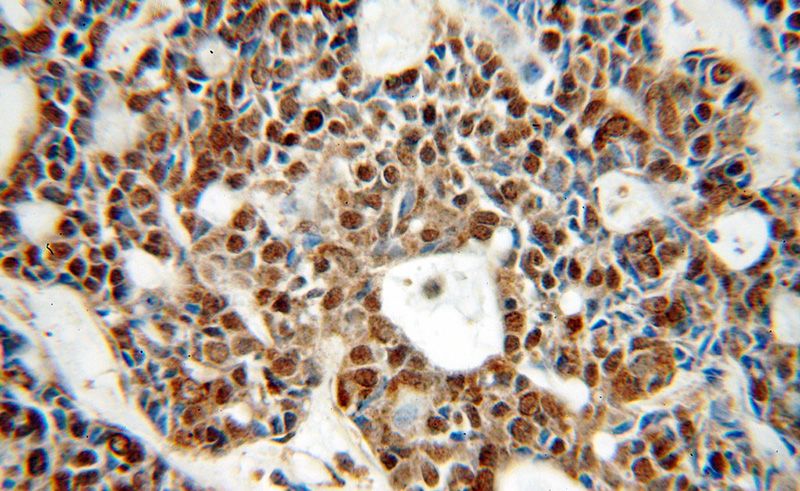 Immunohistochemical of paraffin-embedded human cervical cancer using Catalog No:113046(NCOR1 antibody) at dilution of 1:100 (under 40x lens)