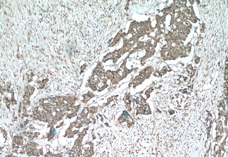 Immunohistochemistry of paraffin-embedded human colon cancer tissue slide using Catalog No:115405(SMURF1 Antibody) at dilution of 1:50 (under 10x lens)