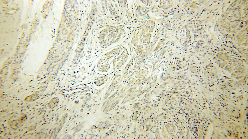 Immunohistochemical of paraffin-embedded human endometrial cancer using Catalog No:115195(SERP1 antibody) at dilution of 1:100 (under 10x lens)