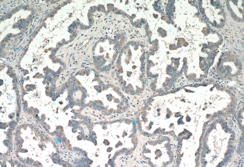 Immunohistochemistry of paraffin-embedded human ovary tumor tissue slide using Catalog No:113869(PIK3R5 Antibody) at dilution of 1:50 (under 10x lens)