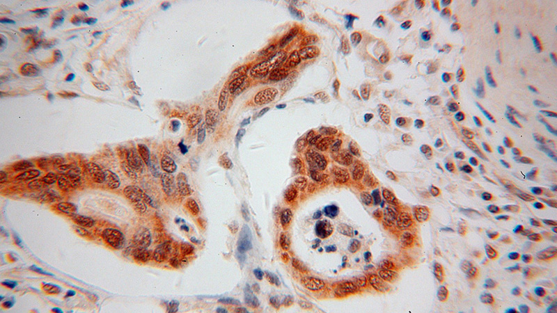 Immunohistochemical of paraffin-embedded human colon cancer using Catalog No:114121(PPFIBP1 antibody) at dilution of 1:100 (under 40x lens)