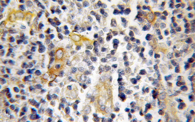 Immunohistochemical of paraffin-embedded human lymphoma using Catalog No:111263(HAX1 antibody) at dilution of 1:50 (under 10x lens)