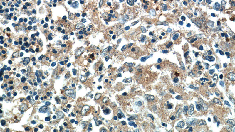 Immunohistochemistry of paraffin-embedded human spleen tissue slide using Catalog No:113773(PFKP Antibody) at dilution of 1:50 (under 40x lens)