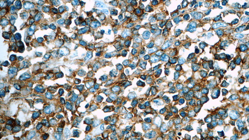 Immunohistochemistry of paraffin-embedded human lymphoma tissue slide using Catalog No:114326(PTPRCAP Antibody) at dilution of 1:50