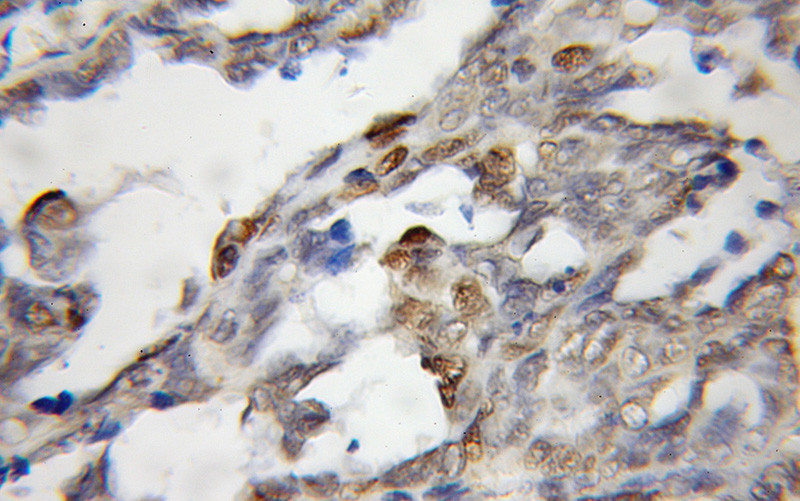 Immunohistochemical of paraffin-embedded human ovary tumor using Catalog No:115715(STK3 antibody) at dilution of 1:50 (under 10x lens)