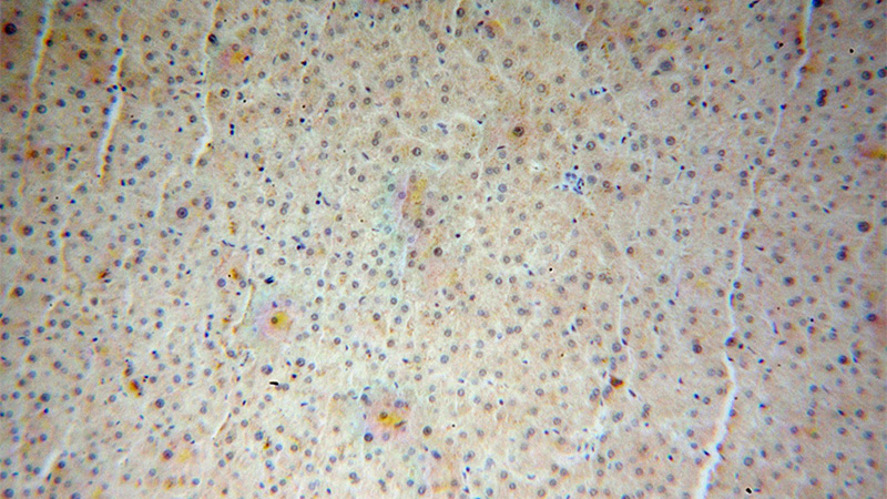 Immunohistochemical of paraffin-embedded human liver cancer using Catalog No:112161(LBP antibody) at dilution of 1:50 (under 10x lens)