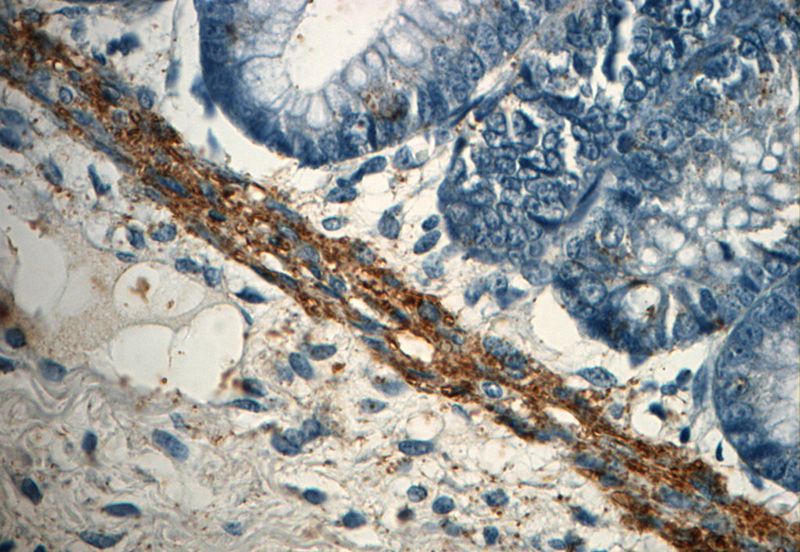Immunohistochemistry of paraffin-embedded human colon slide using Catalog No:110459(FAM111B Antibody) at dilution of 1:50