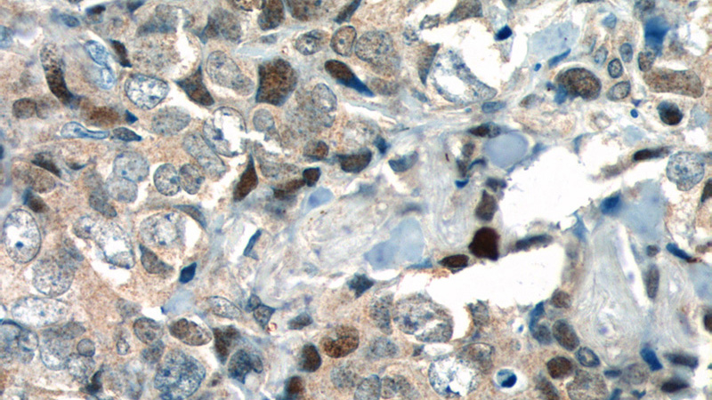 Immunohistochemistry of paraffin-embedded human breast cancer tissue slide using Catalog No:112041(KI67 Antibody) at dilution of 1:400 (under 40x lens). heat mediated antigen retrieved with Sodium Citrate buffer (pH6).