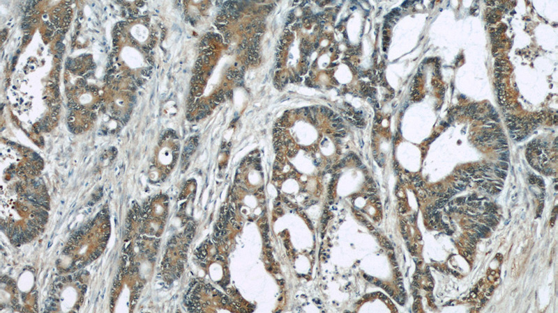 Immunohistochemical of paraffin-embedded human colon cancer using Catalog No:107645(TRIP6 antibody) at dilution of 1:50 (under 10x lens)