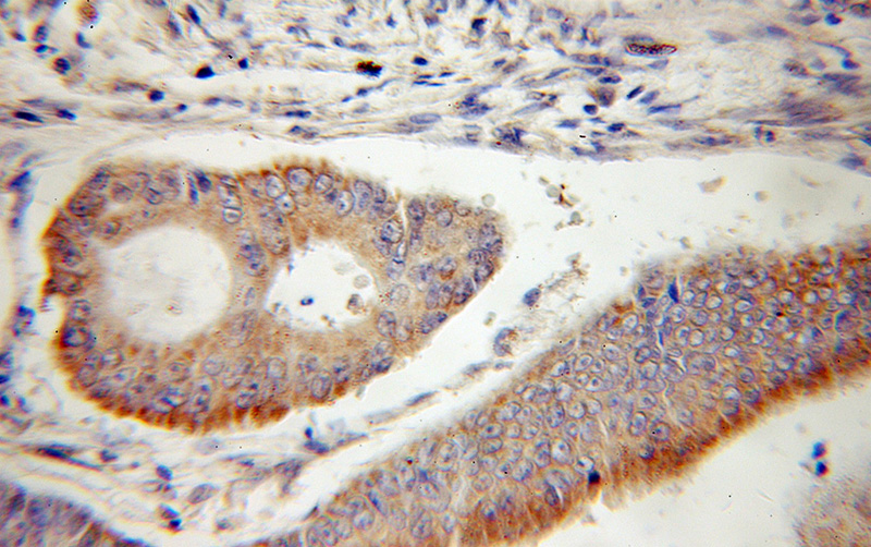 Immunohistochemical of paraffin-embedded human colon cancer using Catalog No:116129(TIMM10 antibody) at dilution of 1:50 (under 25x lens)