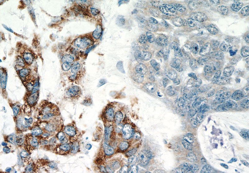 Immunohistochemistry of paraffin-embedded human skin cancer tissue slide using Catalog No:111619(IFIT2 Antibody) at dilution of 1:50 (under 40x lens)