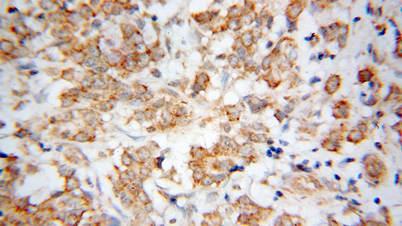 Immunohistochemical of paraffin-embedded human breast cancer using Catalog No:116850(WBSCR16 antibody) at dilution of 1:50 (under 40x lens)