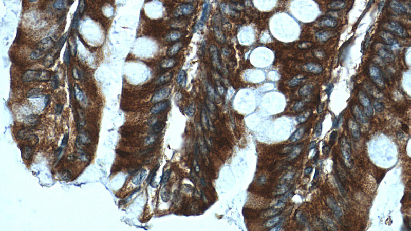 Immunohistochemistry of paraffin-embedded human colon tissue slide using Catalog No:107903(AFAP1L1 Antibody) at dilution of 1:50 (under 40x lens)