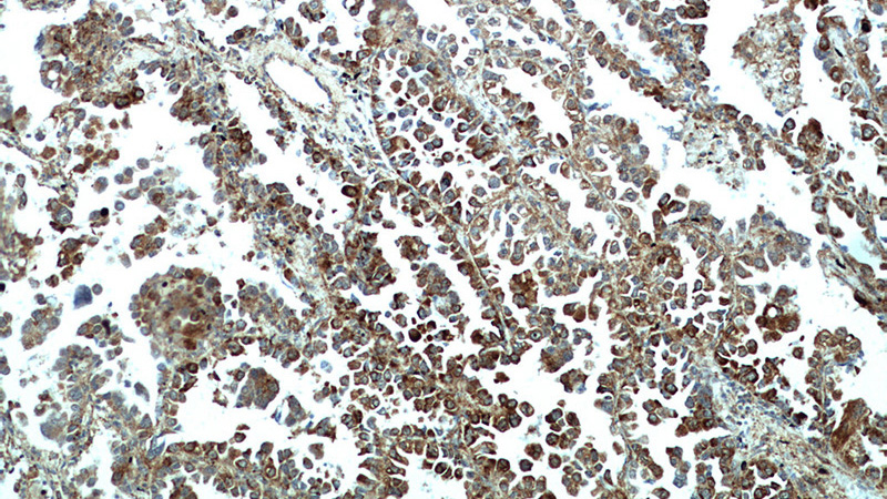 Immunohistochemical of paraffin-embedded human lung cancer using Catalog No:112748(MPP3 antibody) at dilution of 1:50 (under 10x lens)