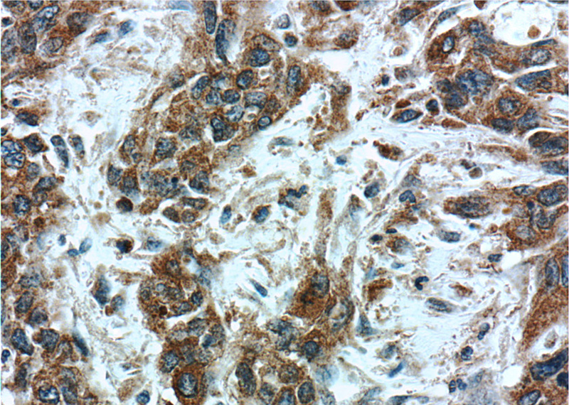 Immunohistochemistry of paraffin-embedded human stomach cancer tissue slide using Catalog No:114252(PSMG3 Antibody) at dilution of 1:50 (under 40x lens)