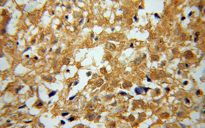 Immunohistochemical of paraffin-embedded human osteosarcoma using Catalog No:109456(COP1 antibody) at dilution of 1:100 (under 40x lens)