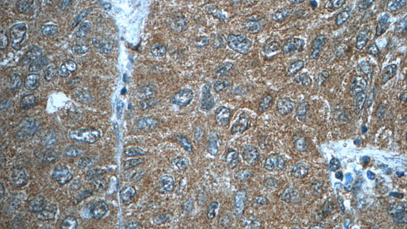 Immunohistochemistry of paraffin-embedded human lung cancer tissue slide using Catalog No:107283(FUT8 Antibody) at dilution of 1:50 under 40x lens