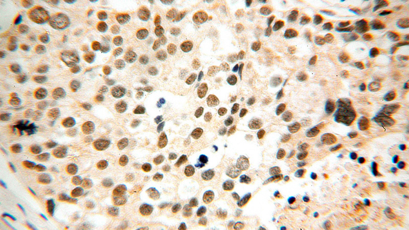 Immunohistochemical of paraffin-embedded human ovary tumor using Catalog No:110488(ETV4 antibody) at dilution of 1:50 (under 40x lens)