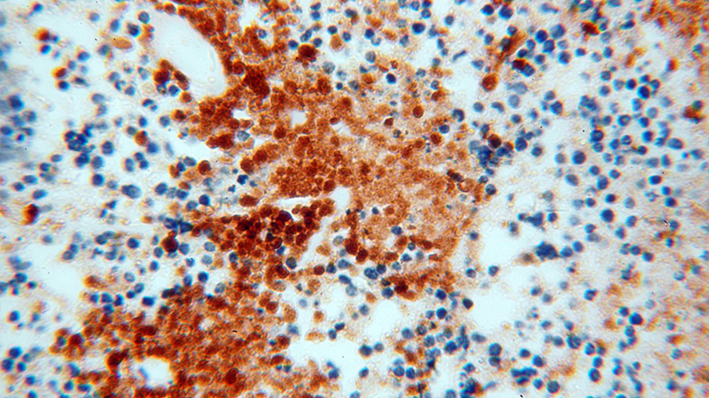 Immunohistochemical of paraffin-embedded human lung cancer using Catalog No:111818(IPO11 antibody) at dilution of 1:100 (under 40x lens)
