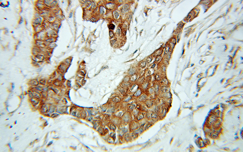 Immunohistochemical of paraffin-embedded human breast cancer using Catalog No:107842(AHCY antibody) at dilution of 1:100 (under 10x lens)