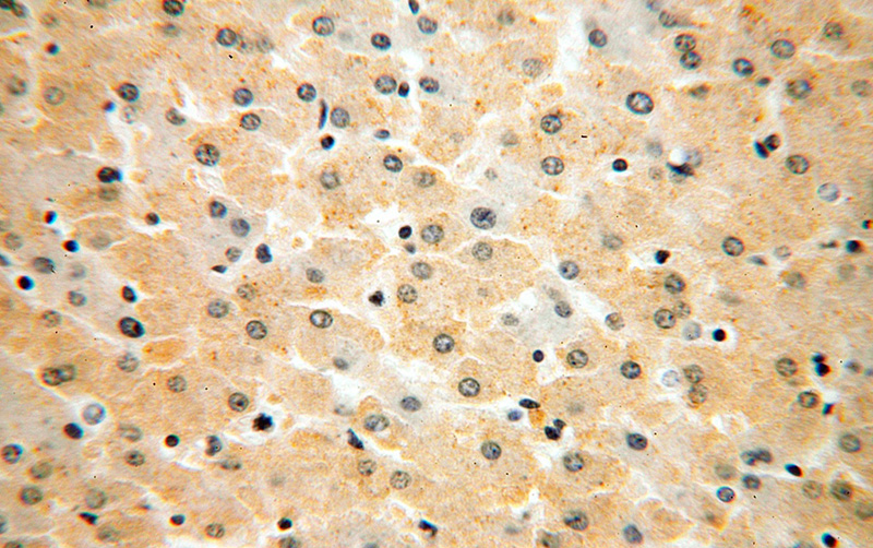 Immunohistochemical of paraffin-embedded human liver cancer using Catalog No:109686(CYP20A1 antibody) at dilution of 1:200 (under 40x lens)