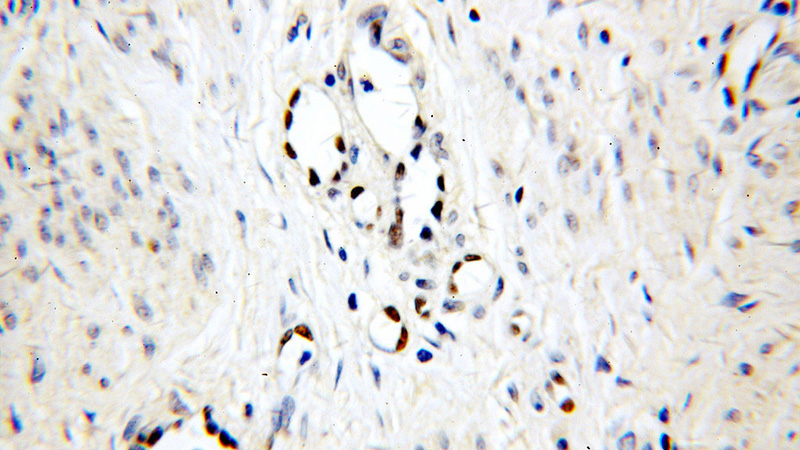 Immunohistochemical of paraffin-embedded human cervical cancer using Catalog No:113967(PLK1 antibody) at dilution of 1:50 (under 40x lens)