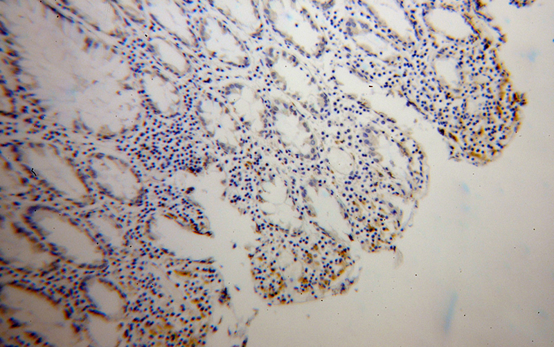 Immunohistochemical of paraffin-embedded human colon cancer using Catalog No:116209(TPP1 antibody) at dilution of 1:50 (under 10x lens)