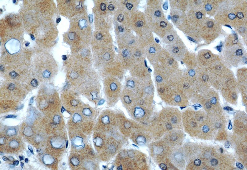 Immunohistochemical of paraffin-embedded human hepatocirrhosis using Catalog No:107403(IL7 antibody) at dilution of 1:50 (under 40x lens)