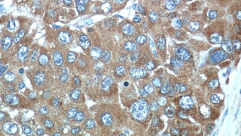 Immunohistochemical of paraffin-embedded human liver cancer using Catalog No:110907(GCLM antibody) at dilution of 1:50 (under 40x lens)