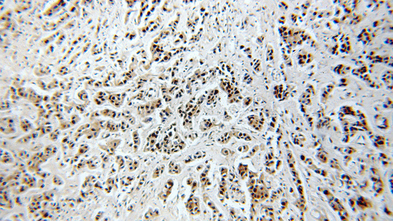 Immunohistochemical of paraffin-embedded human breast cancer using Catalog No:113388(NSUN2 antibody) at dilution of 1:100 (under 10x lens)
