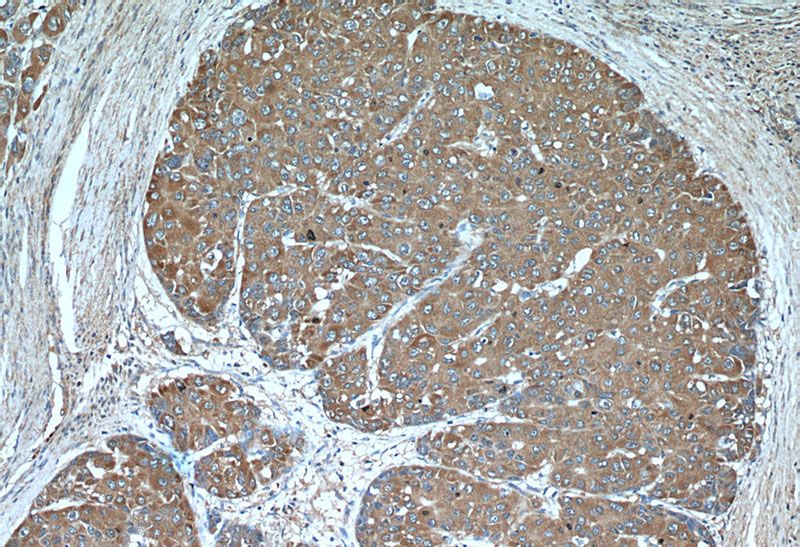Immunohistochemical of paraffin-embedded human liver cancer using Catalog No:110907(GCLM antibody) at dilution of 1:50 (under 10x lens)