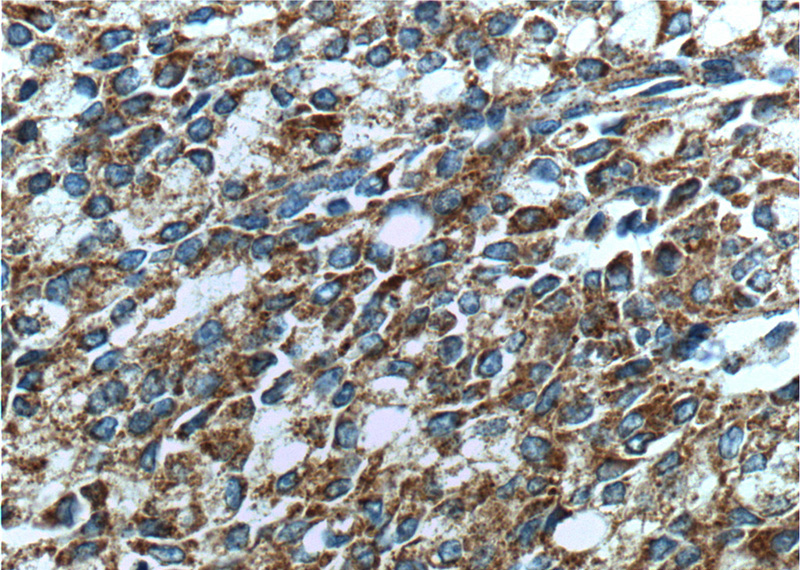 Immunohistochemistry of paraffin-embedded human prostate cancer tissue slide using Catalog No:107486(SLC45A3 Antibody) at dilution of 1:200 (under 40x lens). heat mediated antigen retrieved with Tris-EDTA buffer(pH9).