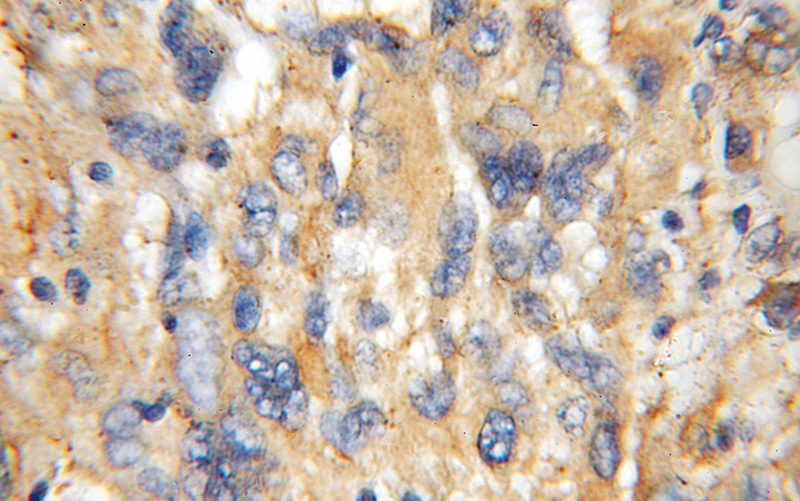 Immunohistochemical of paraffin-embedded human gliomas using Catalog No:116392(TFG antibody) at dilution of 1:100 (under 10x lens)