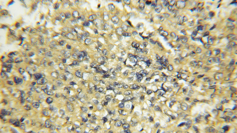 Immunohistochemical of paraffin-embedded human lung cancer using Catalog No:109657(CYB5R3 antibody) at dilution of 1:50 (under 10x lens)