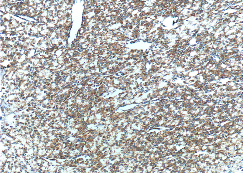 Immunohistochemistry of paraffin-embedded human prostate cancer tissue slide using Catalog No:107486(SLC45A3 Antibody) at dilution of 1:200 (under 10x lens). heat mediated antigen retrieved with Tris-EDTA buffer(pH9).