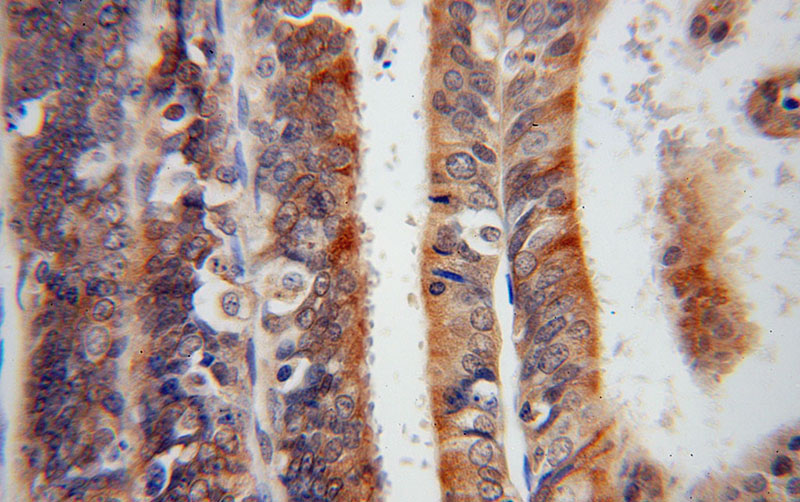 Immunohistochemical of paraffin-embedded human endometrial cancer using Catalog No:115795(STX18 antibody) at dilution of 1:100 (under 40x lens)