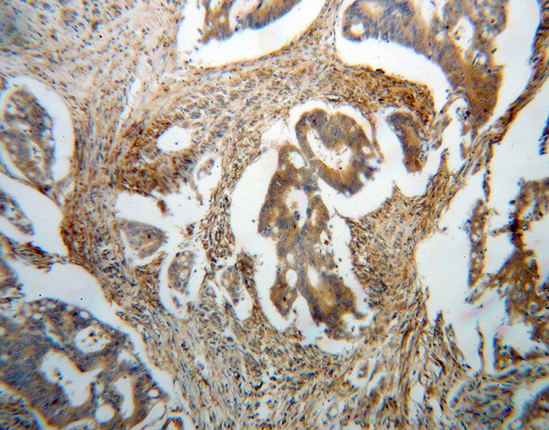 Immunohistochemical of paraffin-embedded human colon cancer using Catalog No:117186(BLMH antibody) at dilution of 1:100 (under 10x lens)